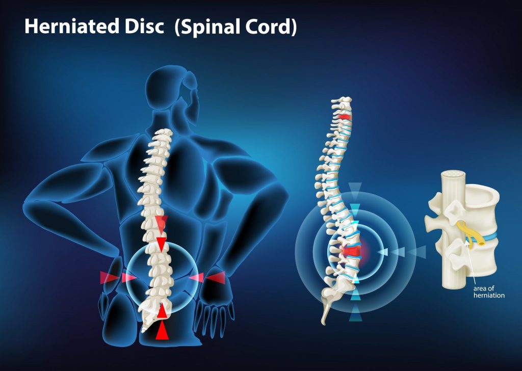 An illustration of a herniated disc in the spinal cord